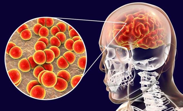tratar-meningitis-sin-antibioticos